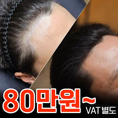 대구두피문신 헤어라인 사례