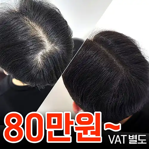 대구두피문신 정수리 사례