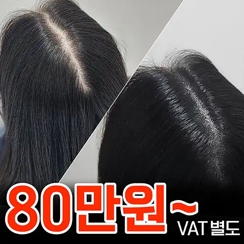 대구두피문신 가르마 사례